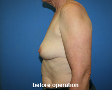 plastic-surgery-breast-augmentation